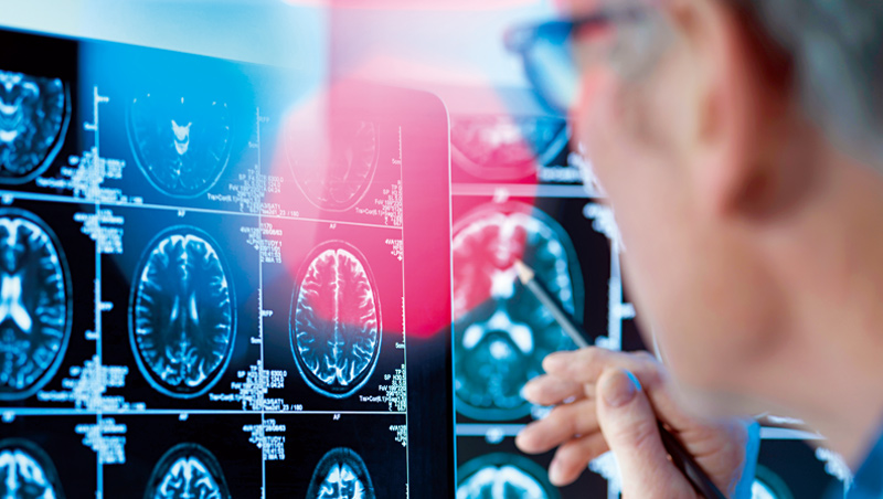 神預測阿茲海默症 IBM讓你寫文章就知道