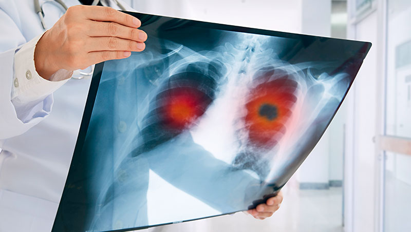 肺癌患者中，有多達8成是罹患肺腺癌，且患者早期多無自覺症狀