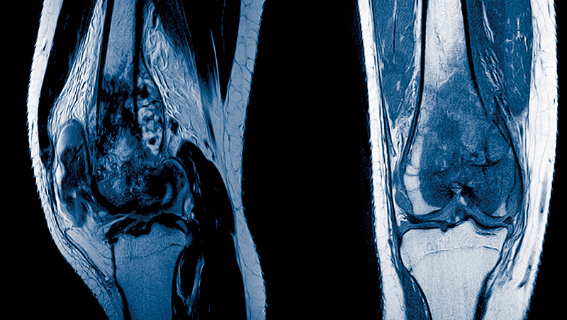 骨癌無法預防　莫名骨痛久不癒快就醫