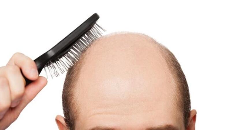 掉髮再嚴重都有救！日本新技術，用一點點毛囊細胞就能長出100倍髮量