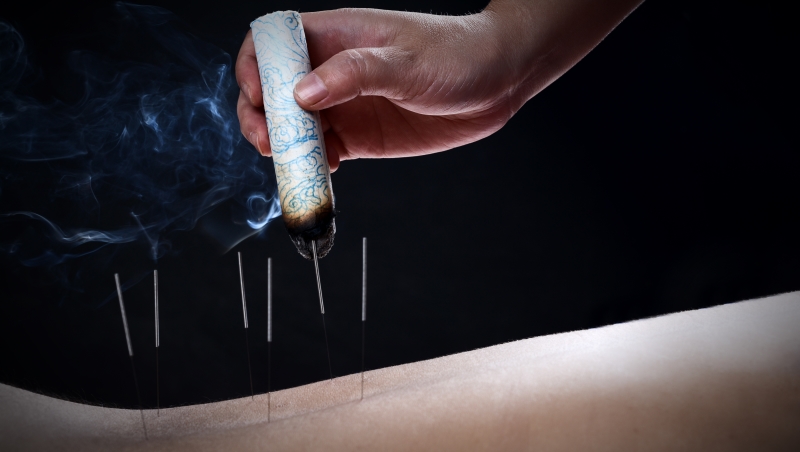 Acupuncture,針灸 Acupuncture,針灸